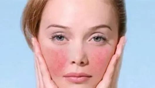 告别高原红淡化红血丝,告别红血丝激素脸