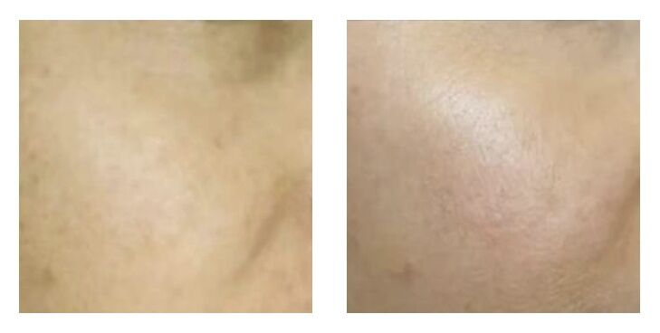 光子嫩肤基础护肤,基础护肤的光子嫩肤