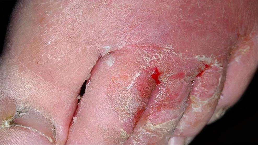 脚上真菌感染脱皮干裂怎么办,脚上脱皮又痒是真菌感染