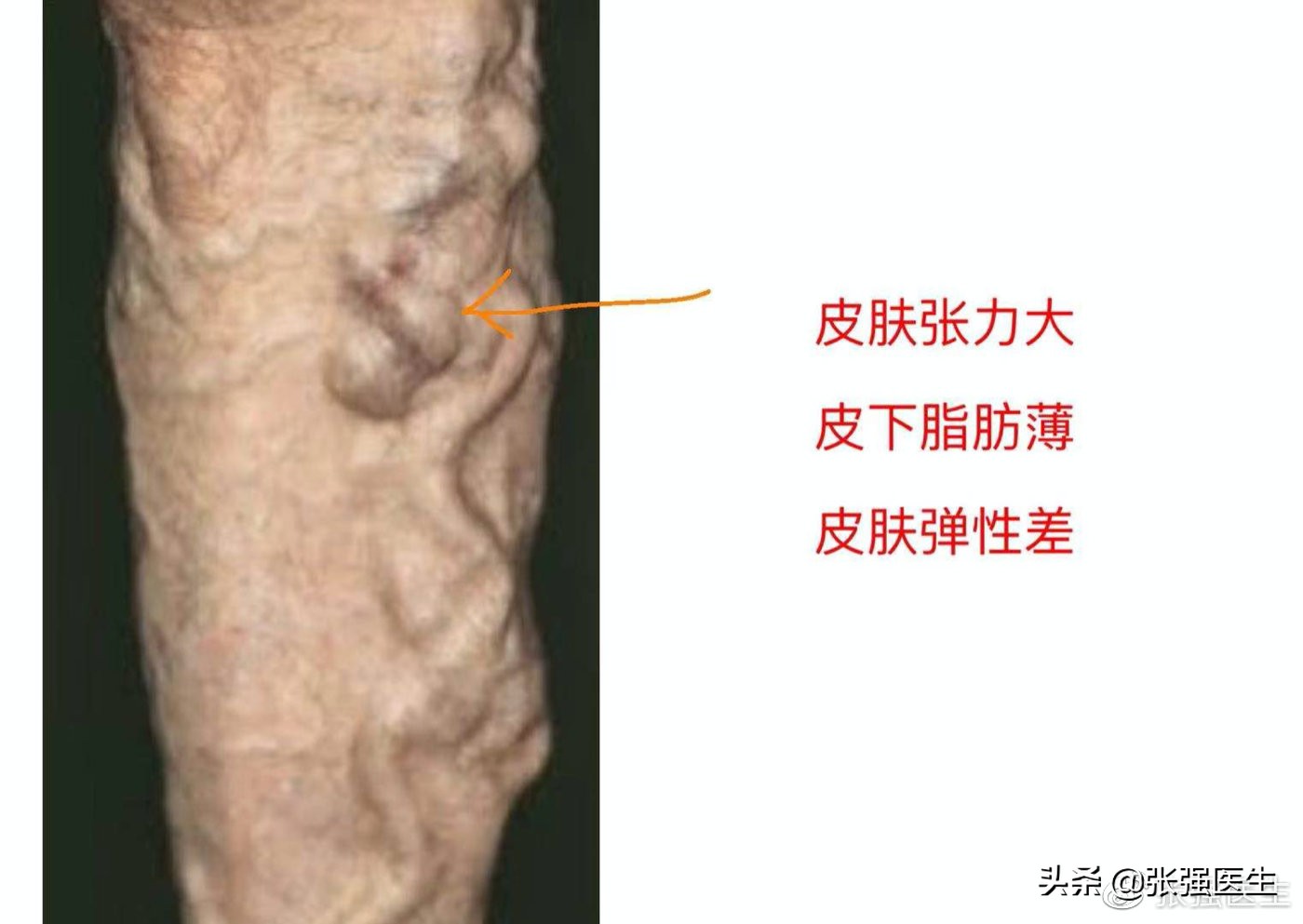 高龄老人静脉曲张破裂怎么办？