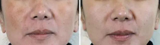 哪些外用药对*褐斑黄**有效?