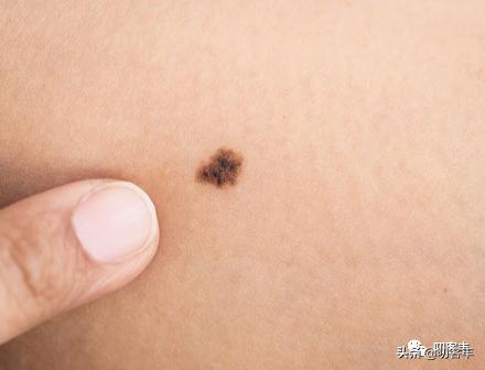 孩子身上有黑色素痣正常吗,孩子身上不规则痣