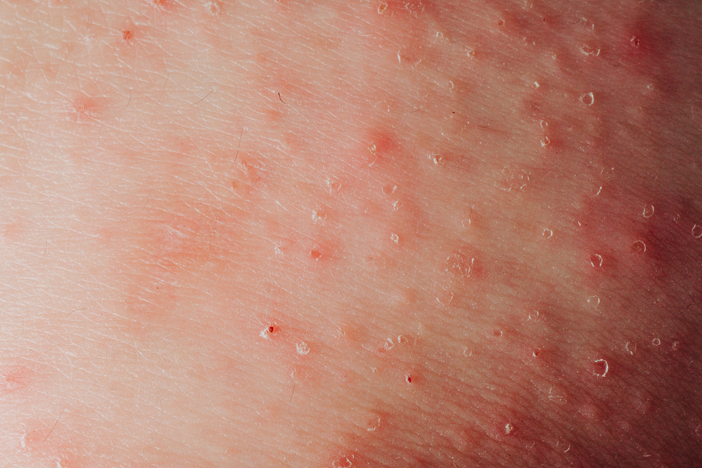 湿疹过来人的独家秘籍,湿疹患者的自救战