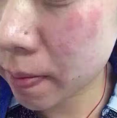 皮肤病外用激素药的副作用有哪些,药疹用激素药半个月副作用