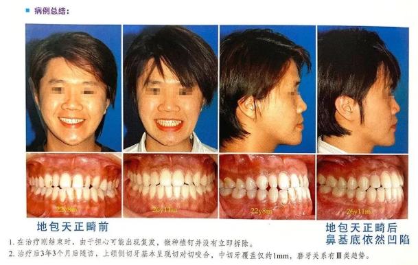 鼻基底严重法令纹很深怎么遮盖,鼻基底凹陷法令纹瘦下去会改善吗