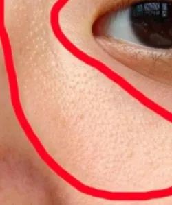 脂肪粒的形成原因以及消除方法,脂肪粒的形成原因以及去除方法