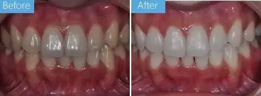 牙白一度颜值瞬间升三度,牙齿白有多重要