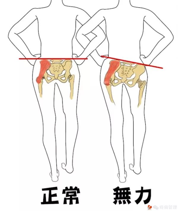 走路屁股扭来扭去是种病，还会导致腰痛、脚痛