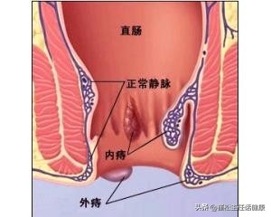 大便出血疼痛是癌症吗,直肠癌和痔疮大便出血的区别