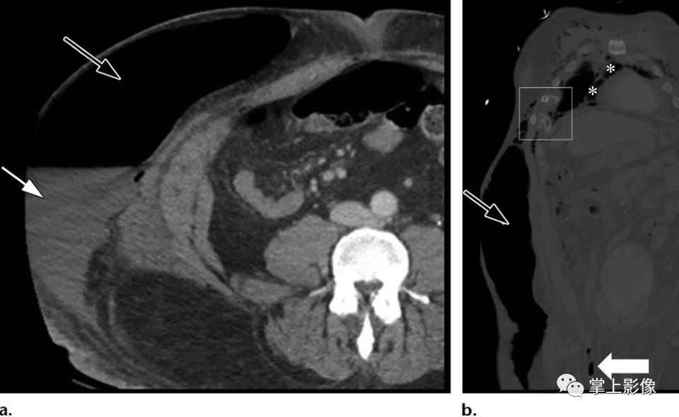 腹壁病变诊断思路,腹部影像诊断读片入门视频