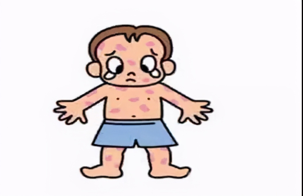 过敏性紫癜是什么症状图片大全,肾型过敏性紫癜的症状能治好吗