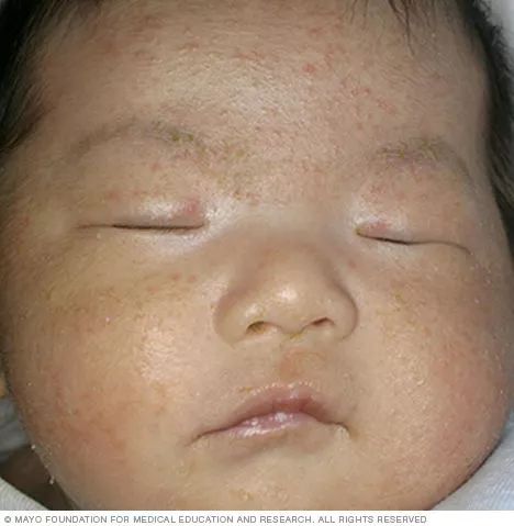 宝宝的疹子到底是什么原因？又该怎么护理？看这篇就够了