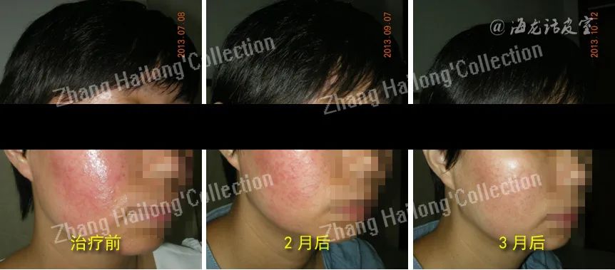 激素依赖性皮炎可以彻底根除吗,激素依赖性皮炎能根除吗