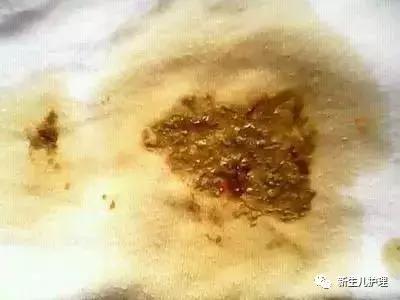 新手爸妈｜奶瓣、绿便、腹泻、便秘……宝宝各种便便真图全解必备