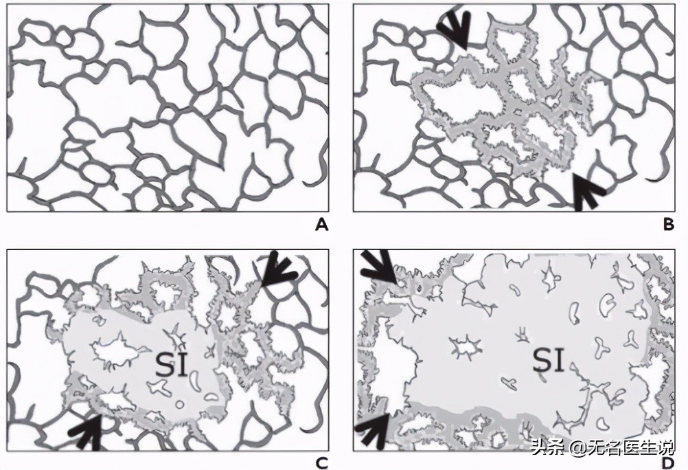 癌症的癌细胞,肺部原位癌是癌症吗