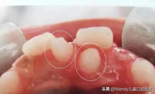 小孩乳牙掉了一直不长是什么原因,小孩乳牙掉了迟迟不出啥原因