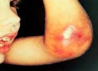 血友病相关知识,小儿血管性血友病