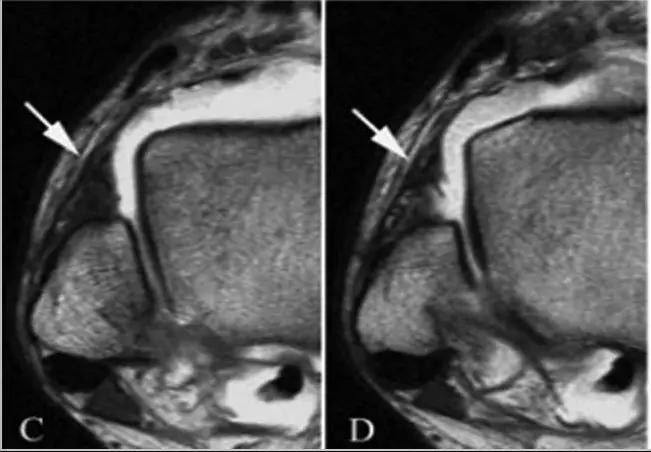 踝关节撞击症问诊,踝关节撞击综合征的x线表现