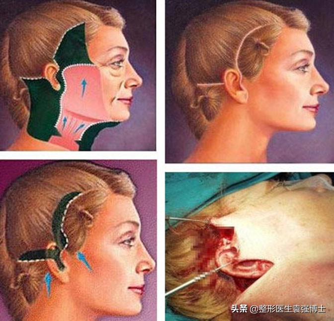 整形法令纹怎么去除最快最有效,整形医院可以去除法令纹吗