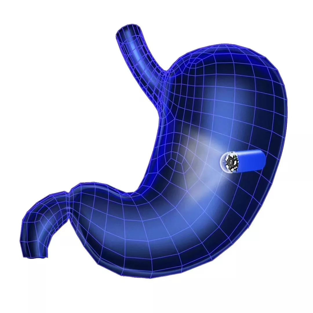 胃镜无法通过是什么原因,胃镜可以替代喉镜检查吗