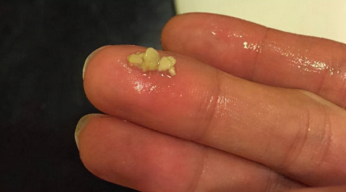 男孩口臭被嫌弃,六岁男孩口臭严重