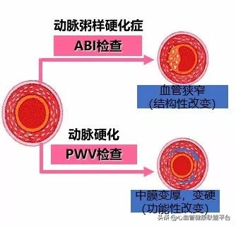 硬核科普｜血压检测不能少，动脉硬化你知多少？