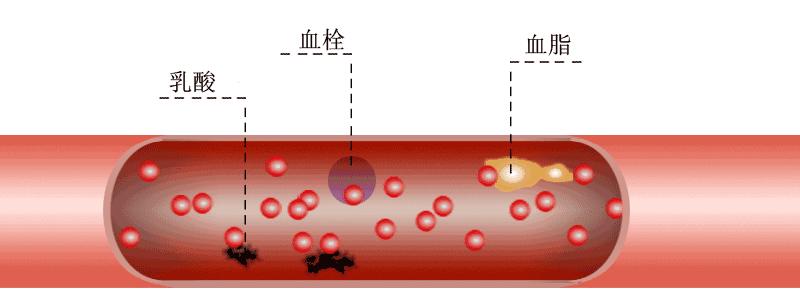 怎样预防脑梗死复发,如何预防脑梗死复发
