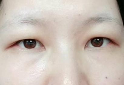 割双眼皮是种什么体验,割双眼皮什么样子才是增生