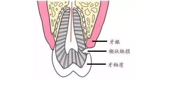 刷牙导致楔状缺损,楔状缺损刷牙牙龈痛