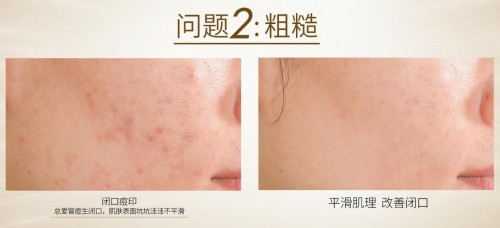 澳洲cemoy面霜真的好用吗,cemoy面霜修红测评