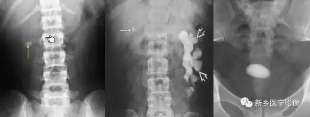 腹部平片可以看出肠胃疾病吗,腹部散在结节状高密度影