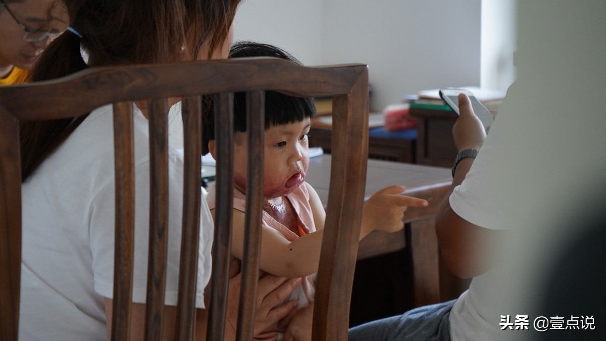 意外毁容真实案例,因为一次意外毁了女孩的一生