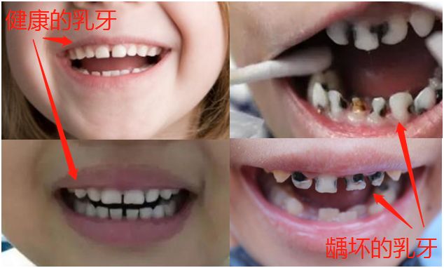 孩子的乳牙要掉了可以拔吗,小孩的乳牙真的可以治疾病吗