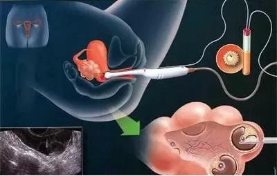 试管取卵取出了空卵泡该怎么办？会影响成功率么？