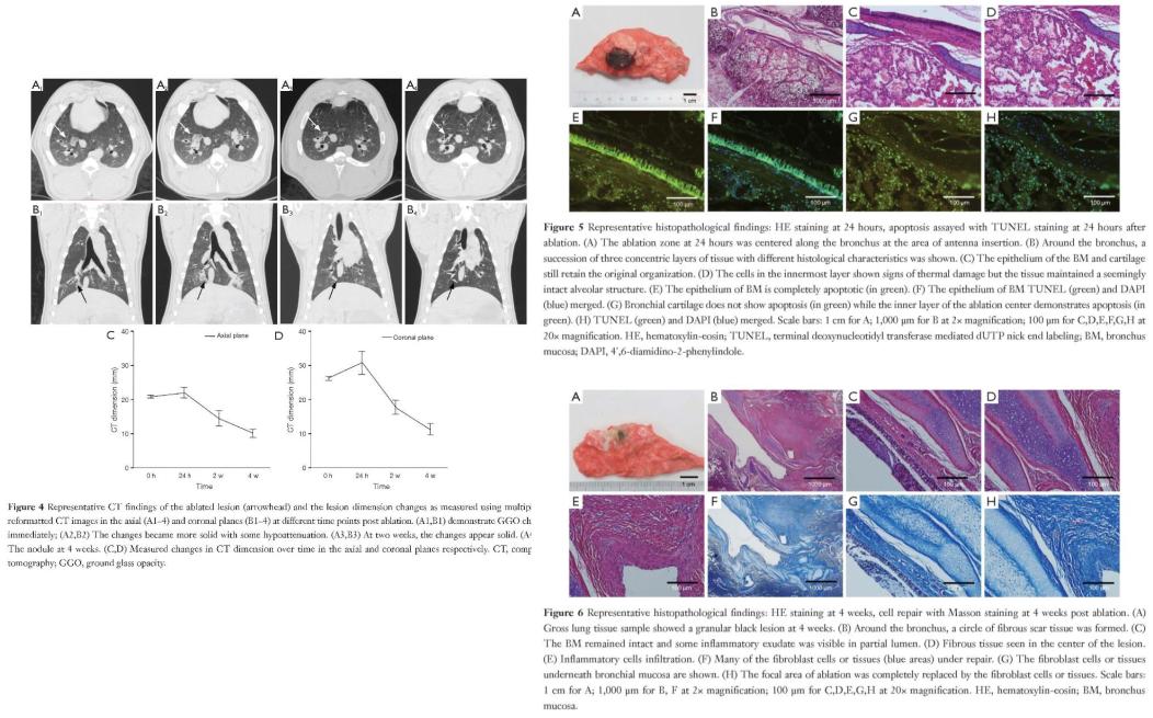 孙加源门诊,治疗肺癌的新技术新手段