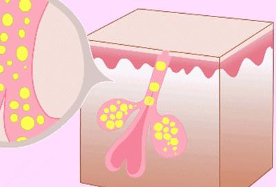 反孔大作战专治你的毛孔粗大