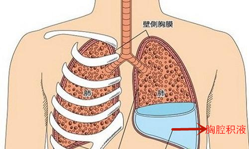 胸腔积液能抽干净吗,胸腔积液能随意抽吗