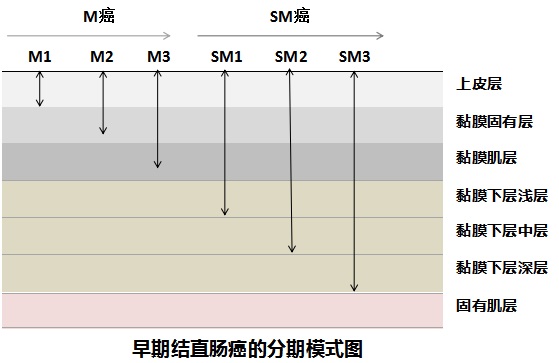 直肠癌超低位保肛手术记录,极低位直肠癌保肛手术