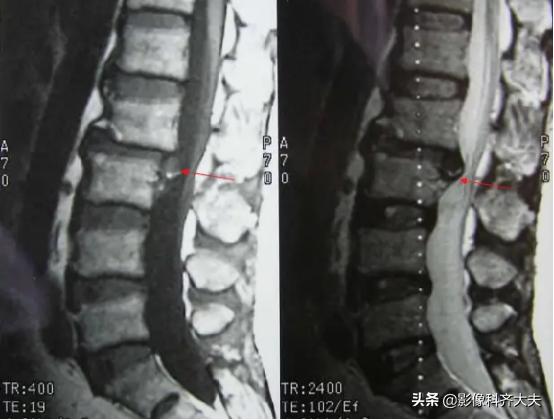 腰椎间盘突出是什么,腰椎间盘突出和腰间盘突出有区别吗