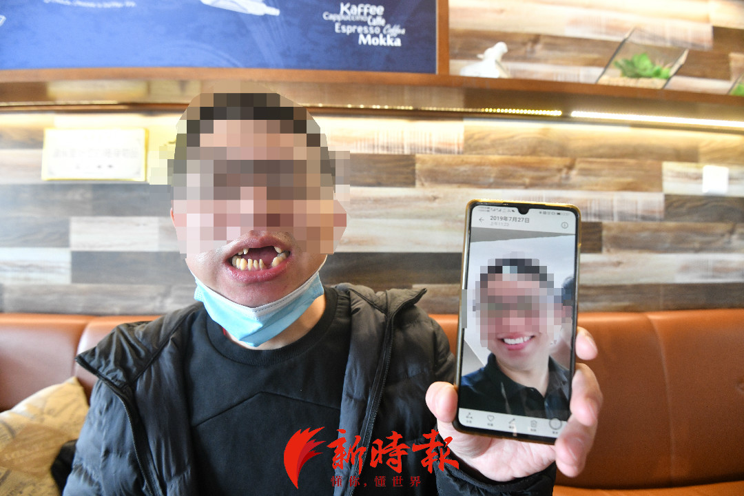 济南牙齿残根修复,济南一男子修牙后变鲨鱼齿