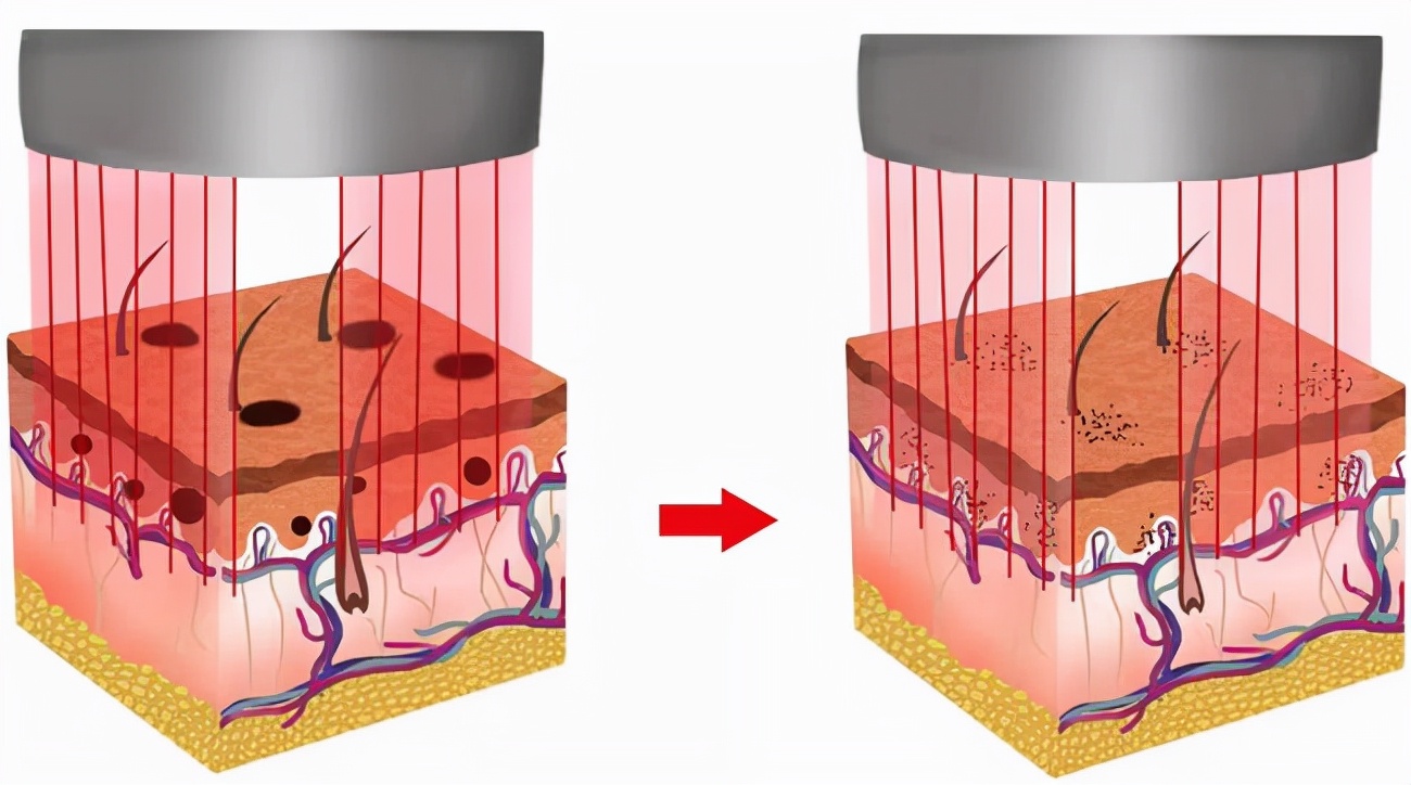 鼻唇沟苹果肌下垂怎么做,苹果肌下垂鼻基底凹陷做什么项目