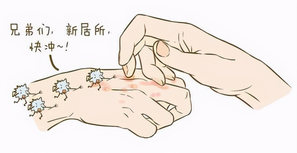 脚气到底是个啥？咋样才能预防脚气