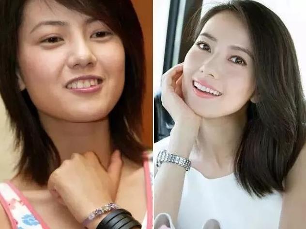 揭露欧美明星牙齿美白的秘密,牙齿美白最好的方法大黄牙