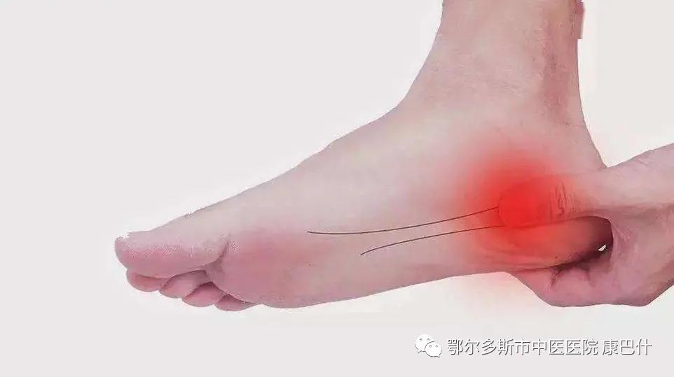 足底筋膜炎运动康复视频,认识足底筋膜炎如何预防和康复