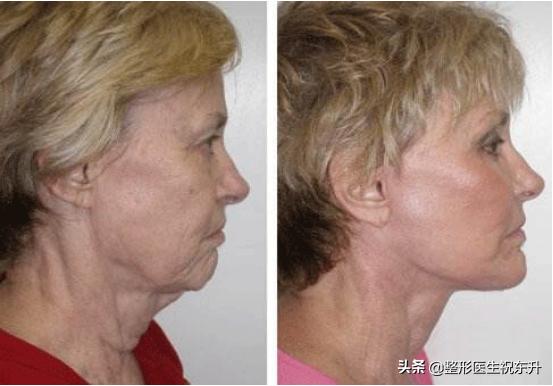 大拉皮手术失败,大拉皮手术后不流行