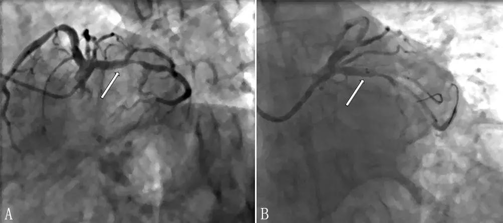 心肌梗死两年心电图正常怎么回事,心电图检查心肌梗死心肌酶正常