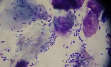 头皮屑过多怎么去除头皮屑,头皮屑特别多如何去掉头皮屑