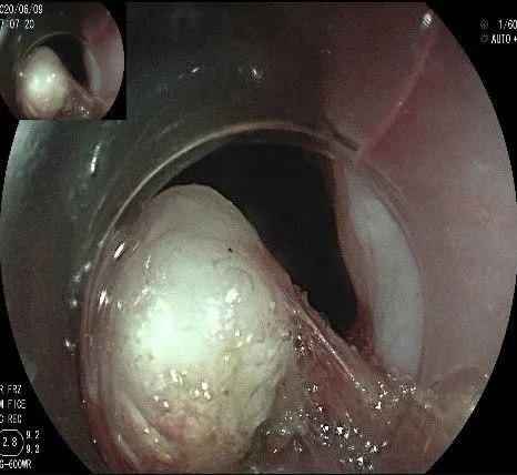 贲门隆起性病变影像,贲门溃疡隆起性病变
