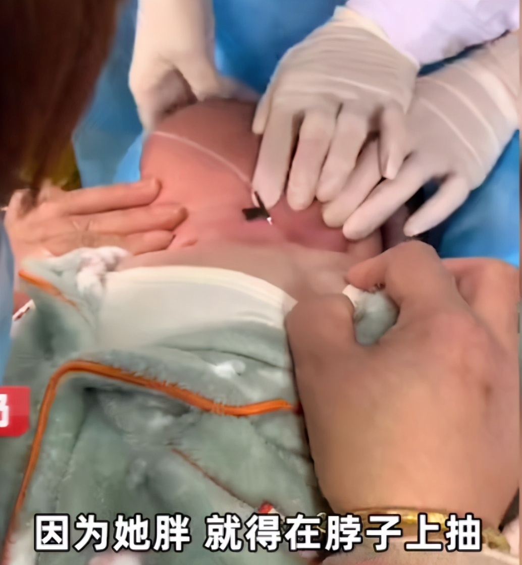 大头娃娃婴儿面霜,激素面霜导致的大头娃娃