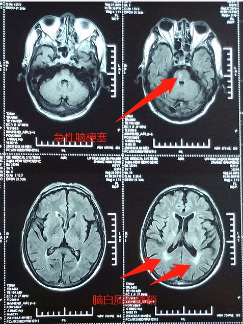 手指麻木不一定是颈椎病